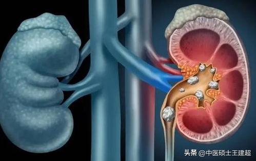 肾结石吃玉瓜好不好,肾结石患者食用玉瓜的利弊分析
